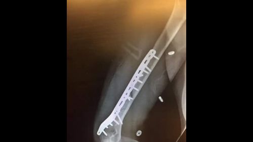 Lindsey Vonn is the fracture 'humerus in training